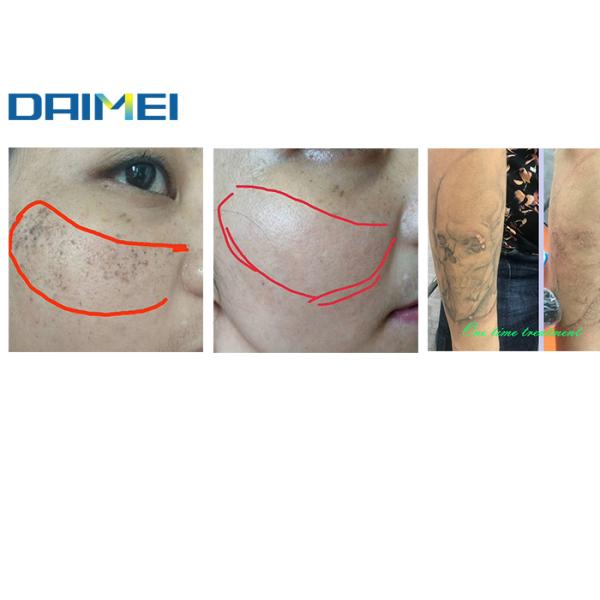 High Power Picosure Tattoo Removal Machine / Pico Genesis Laser CE Approved