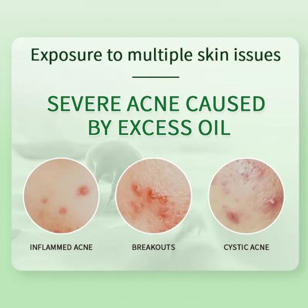 Глубокое очищение Противоактивное восстановление бледное акне отметка акне лечение крема