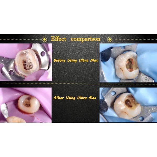 Ультра блок активатора портативный зубоврачебный звуковая война 40000 HZ высокочастотная