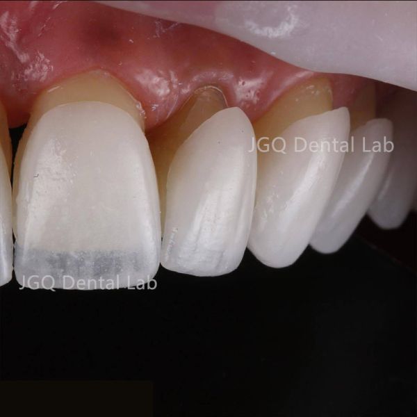 High Translucency Cast Porcelain Emax Veneers China Dental Lab OEM