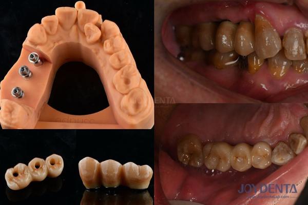 Ultra Hard Colour Stability Dental Implant Crown OEM Easy Maintain Long Lasting