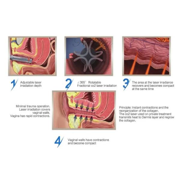 Портативная частичная красота удаления угорь шрама машины лазера СО2 10600nm