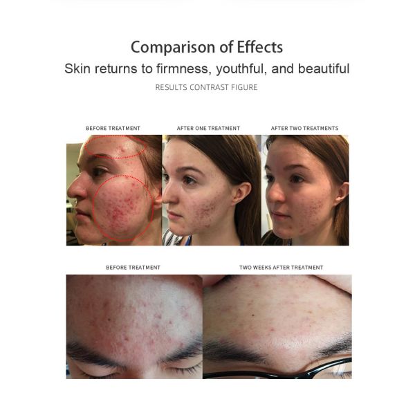 Skin Rejuvenation Face Lift Wrinkle Removal 2 In 1 Ultrasonic Hydor Space Plasma Machine