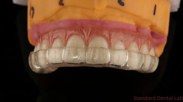 Professional Zirconia Dental Implant Crown Titanium CAD CAM Zirconia Crown China Dental Lab