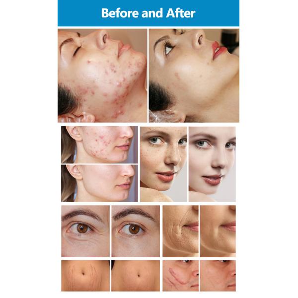 Регулируемая 1-60 Вт лазерная машина для удаления шрамов