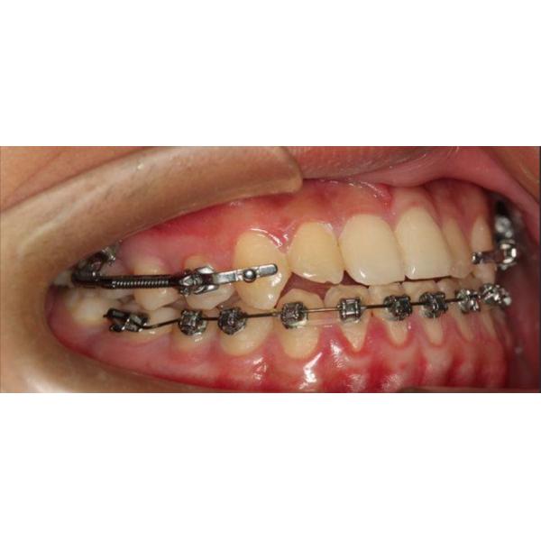 Устройство для лингвальной и ротовой молярной дистализации в ортодонтии из нержавеющей стали