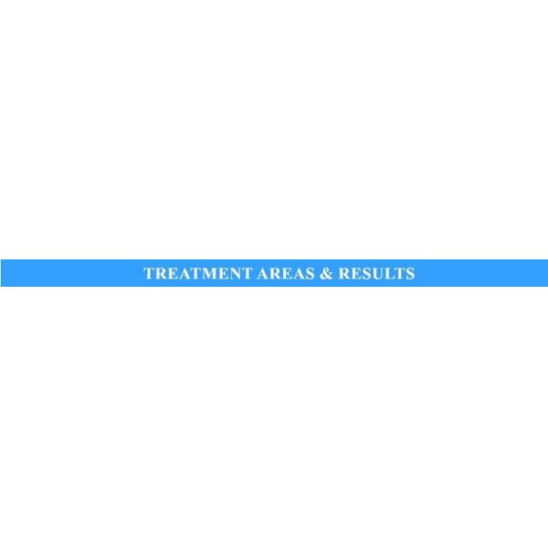 Skin Rejuvenation and Acne Pigmentation Treatment with Vertical IPL Hair Removal Machine