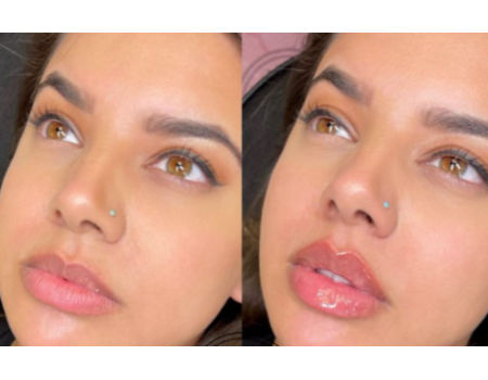 Juvederm Ultra 3 Hyaluronic Acid Dermal Filler For Face Lips