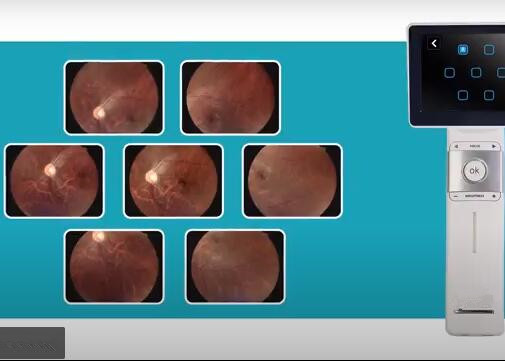 Телемедицины камеры Fundus офтальмоскопа пикселы разрешения 1280 x 960 портативной Handheld доступные видео-