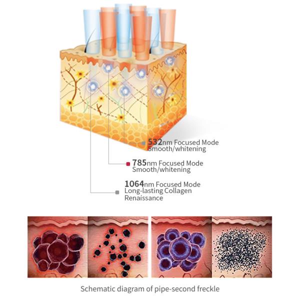 Máquina de eliminación de tatuajes con láser de picosegundos 532nm 755nm 1064nm