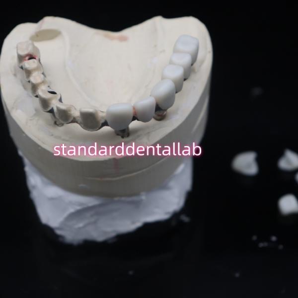 Полная арка Мало мост зубная реставрация циркониевые короны с резинкой Поэцелианская Китайская стоматологическая лаборатория