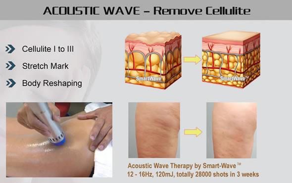 Shock wave therapy equipment home use medical smart-wave for diabetic foot treatment