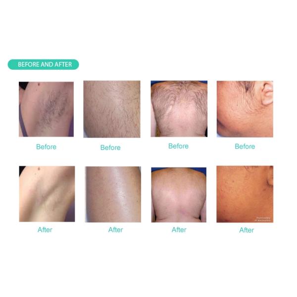 808 - 810 nm Diode Laser Removal Hair Machine With Non Channel Handle