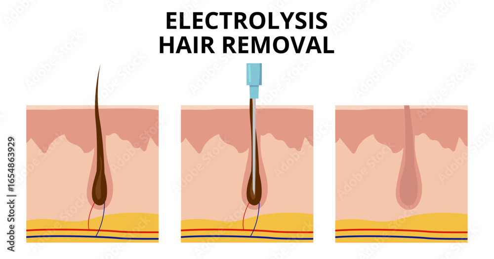 Needles RF 13.56MHz Radio Frequency Electrolysis for Safe Permanent Hair Removal and Vascular Therapy