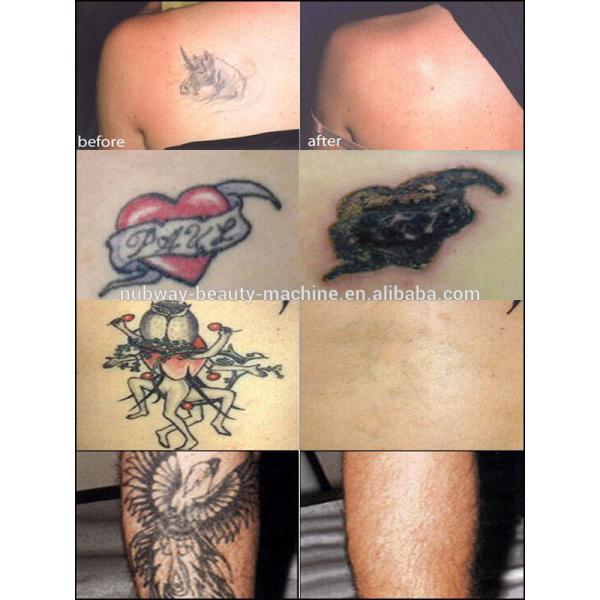 Portble all color tattoo removal nd yag laser tattoo removal machine