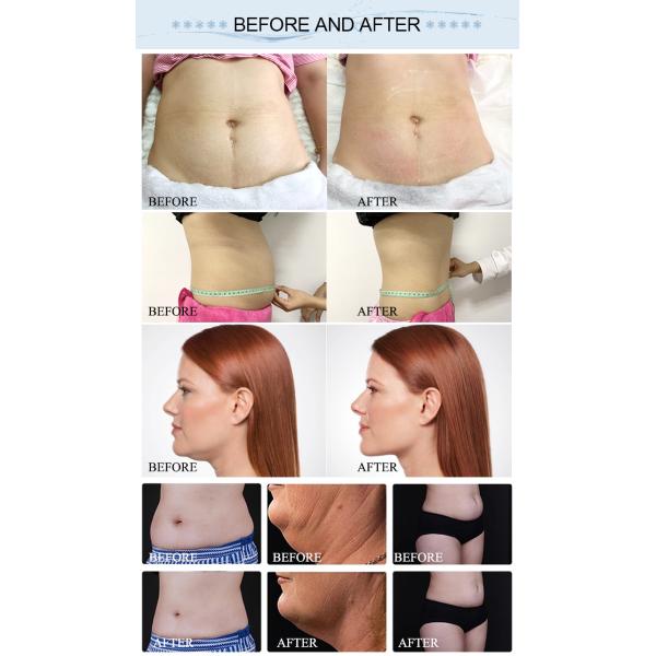 Best Cryolipolysis For Fat Reduction And Body Contouring - 5 Cryo Handles For Abdomen, Arms And Thighs, Double Chin