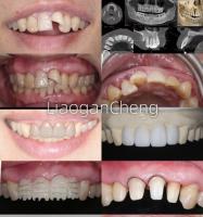 Biocompatibility Safe Zirconia Dental Crowns For Long-term And Implant-supported Restorations
