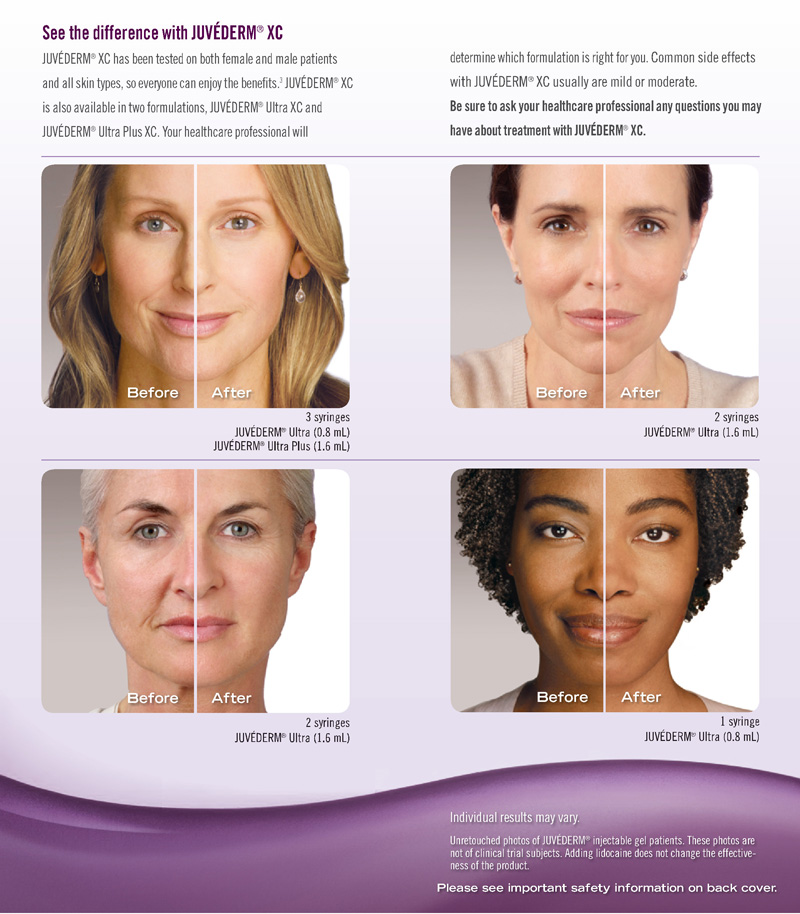 Впрыска заполнителя Ultra3 Ultra4 Juvederm Voluma дермальная для глубоких морщинок