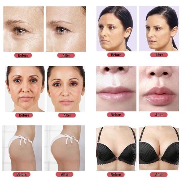 Facial Hyaluronic Acid Dermal Filler Room Temperature Sterile Syringe