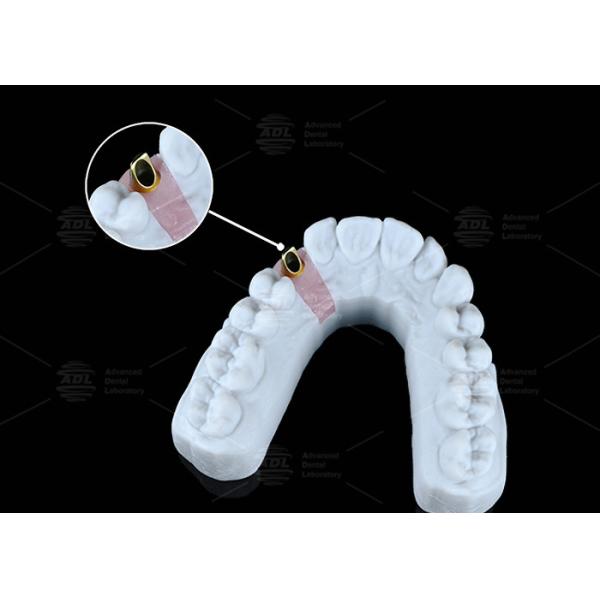 Универсальный угловой винтовой канал совместим с системами CAD / Cam