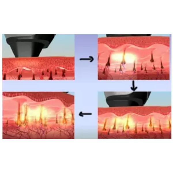 808 810nm Diode Laser Hair Removal Machine For Dark Skin High Performance