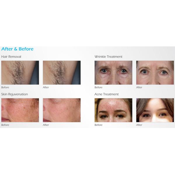 Painfree Hair Removal Skin Rejuvenation IPL Laser Equipment IPL SHR Machine