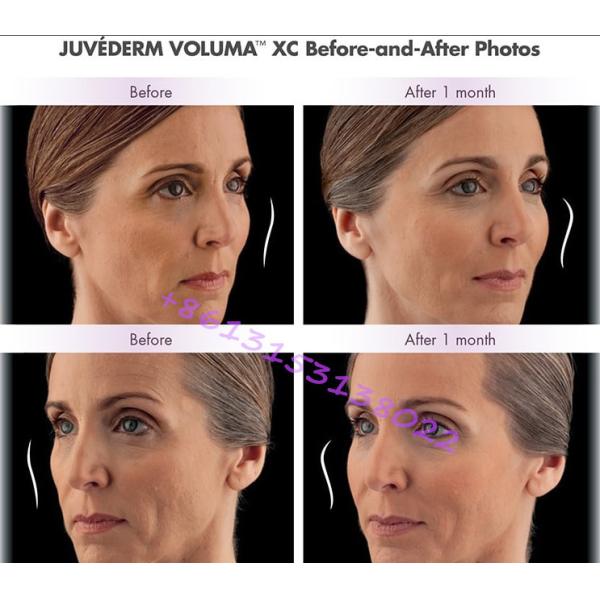 Long Lasting Hyaluronic Acid Facial Filler Juvederm Voluma Cheek Filler