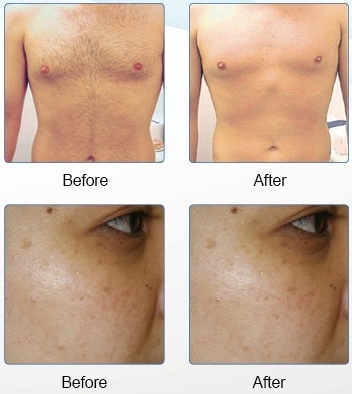 Multifunction Beauty  Devices SHR IPL SHR Hair Removal Machine