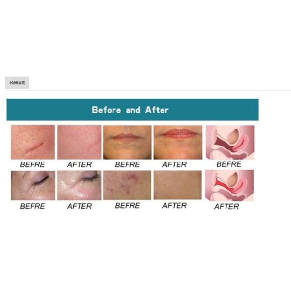 Puffiness машины 10600nm лазера портативного СО2 двуокиси 60W частичный анти-