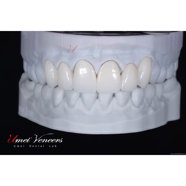 Natural White Cast Porcelain Veneers