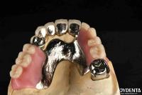 Elaborate Framework Final Set Stable Dental Structure Designed Teeth Finish