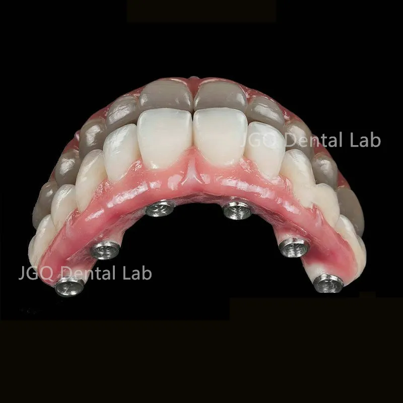 Ball-Cap Implant Overdenture Offers Excellent Stability and Retention Suitable for Elderly Patients Lab Prices