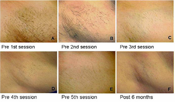 2017 Newest Germany import radiator 808nm permanent hair removal machine 808nm diode laser