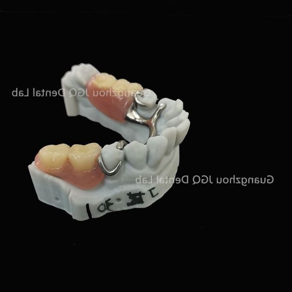 Durable Metal Framework Dentures Removable 3D Printing Process