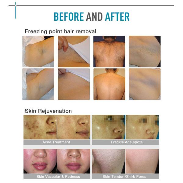 Permanent OPT E Light SHR IPL Laser Hair Removal Machine 1-10 Pulses