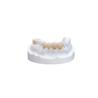 Inlays Onlays Ceramic Dental Crown Strong Veneer For Dental Department