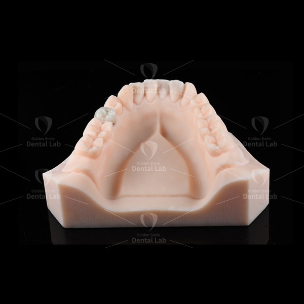 74% Yellow Gold Crown PFM High Noble Porcelain Fused To Metal Crown