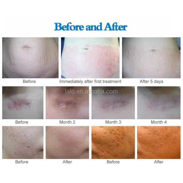 Dr pen M5 gold dermapen anti-aging derma roller pen microneedle therapy skin rejuvenation