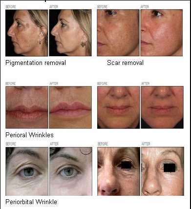 RF Metal Tube Fractional Co2 Laser For Acne Scars / Hircus / Wrinkle Removal