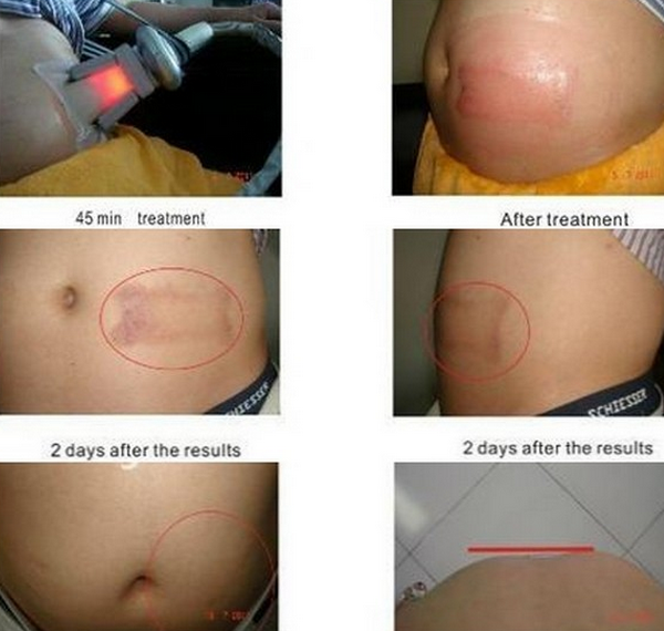 Weight reduction Cryolipolysis Slimming Machine with CE Certification