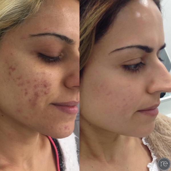 máquina de la elevación de cara del retiro de la cicatriz 5Mhz Microneedle RF