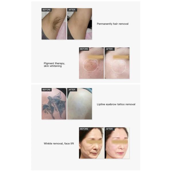 1000Mj лазер диода машины 755nm 808nm 1064nm корки углерода лазера ND YAG