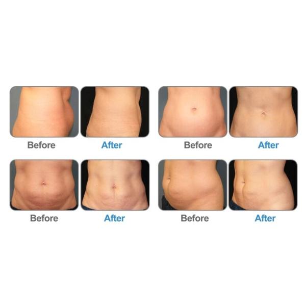 High Power Fat Freezing Coolsculpting Cryolipolysis Machine With 4 Cryo Handles