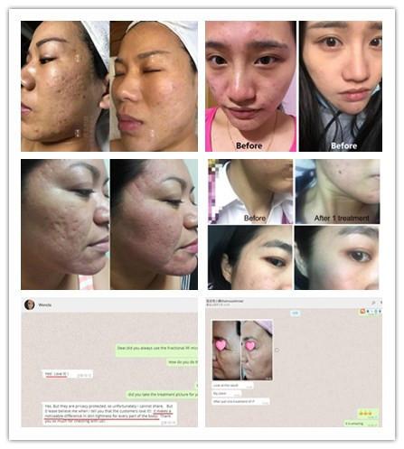 Radiofrequency Skin Tightening Fractional RF Microneedle For Face / Body