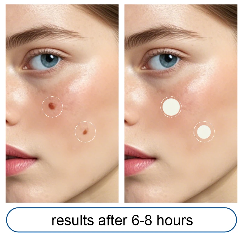 Multi Skin Tone Hydrocolloid Acne Patches Invisible Blemish Coverage Universal Fit