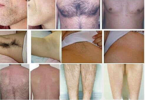 Оборудование удаления волос безболезненного удаления волос салона красотки лазера диода подкрыльцовое