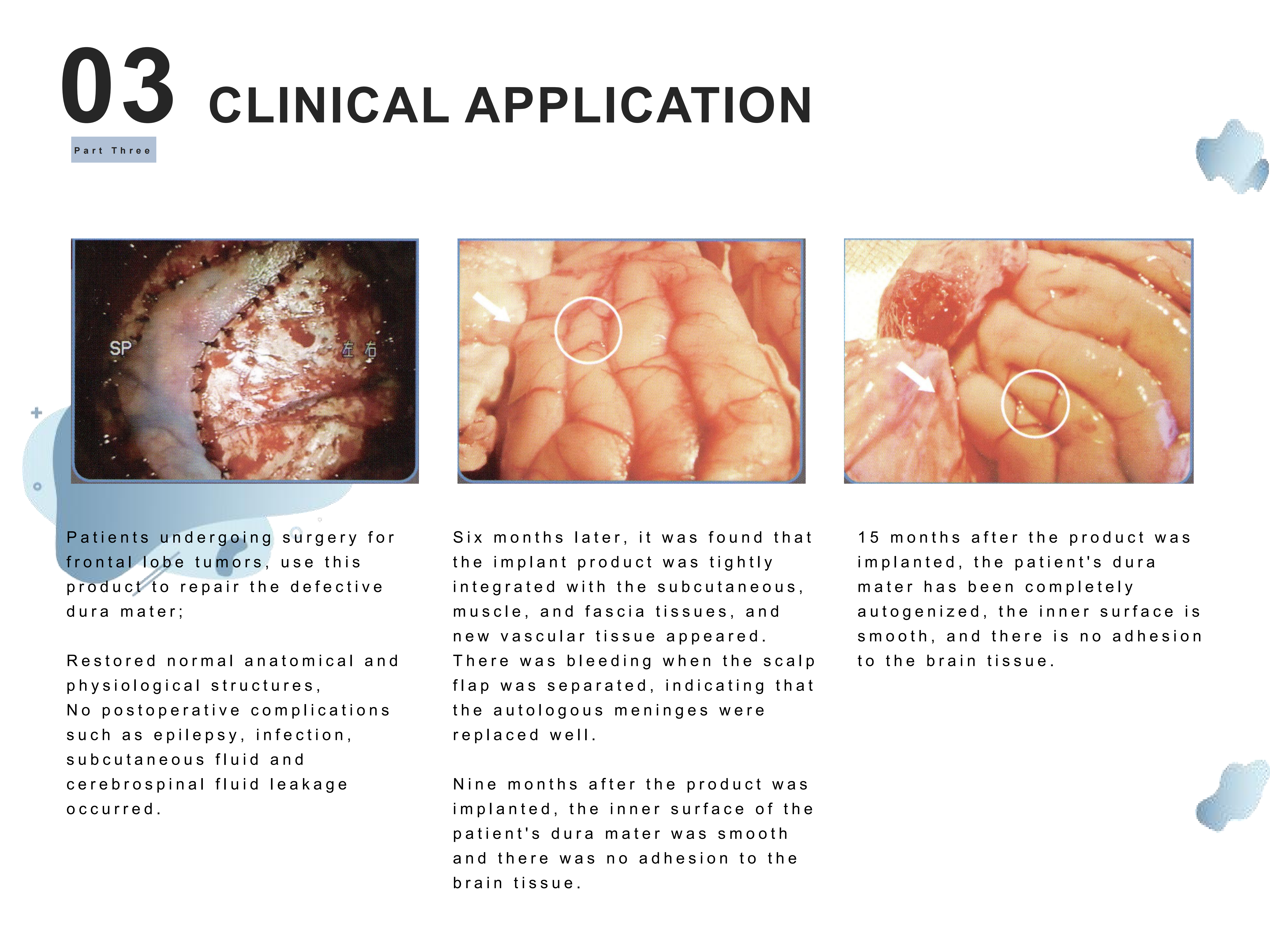 Safe Porcine Collagen Dura Patches High Compatibility Dura Repair CSF Fistula Prevention