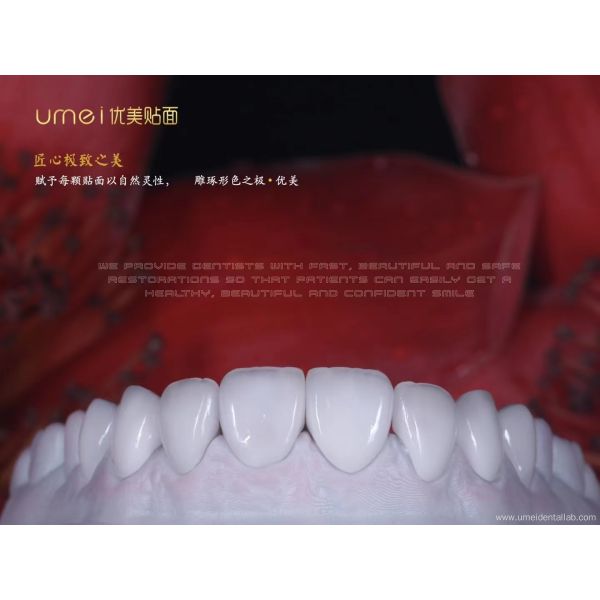Ultra-thin aesthetic dental veneers