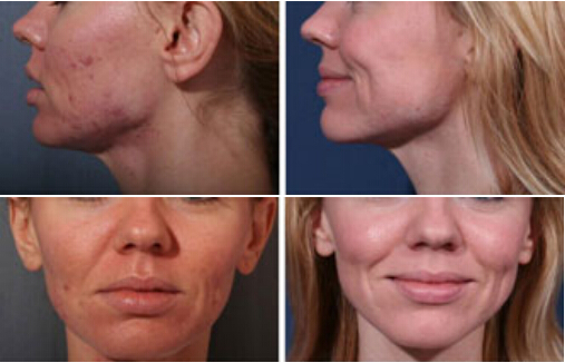 Co2 Fractional Laser Machine Wavelength 10600 nm Rated Power 800 Watt Net Weight 52 Kgs