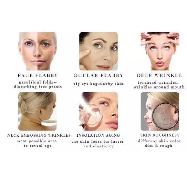 Home Use Mini HIFU Facelift Machine Hello skin HIFU face lifting